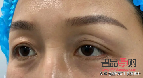 探究上眼皮松弛嚴(yán)重問題及其解決方案