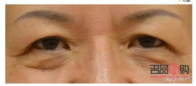 探究上眼皮松弛嚴(yán)重問題及其解決方案