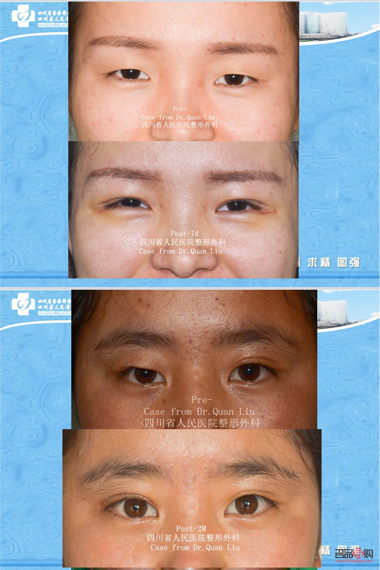 大綜合雙眼皮案例圖片(大綜合雙眼皮案例圖片高清)