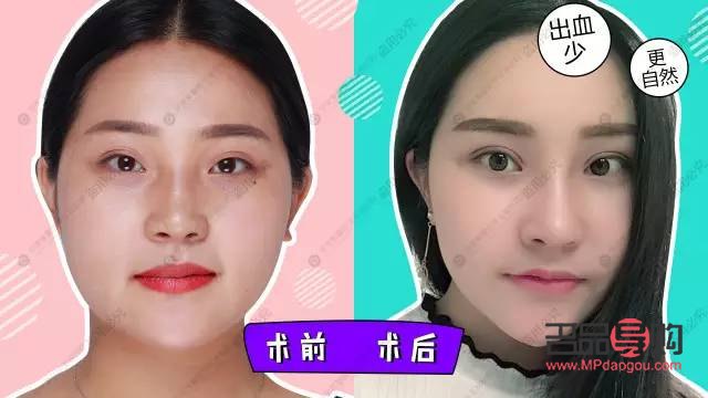 做雙眼皮具備的條件(做雙眼皮具備的條件是什么)