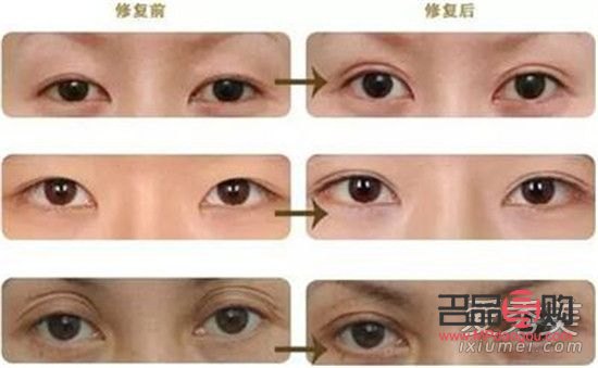 <h3>雙眼皮做窄了能修復(fù)嗎？</h3>