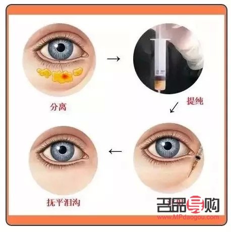 <h3>紅霉素眼膏去眼袋的最快方法</h3>