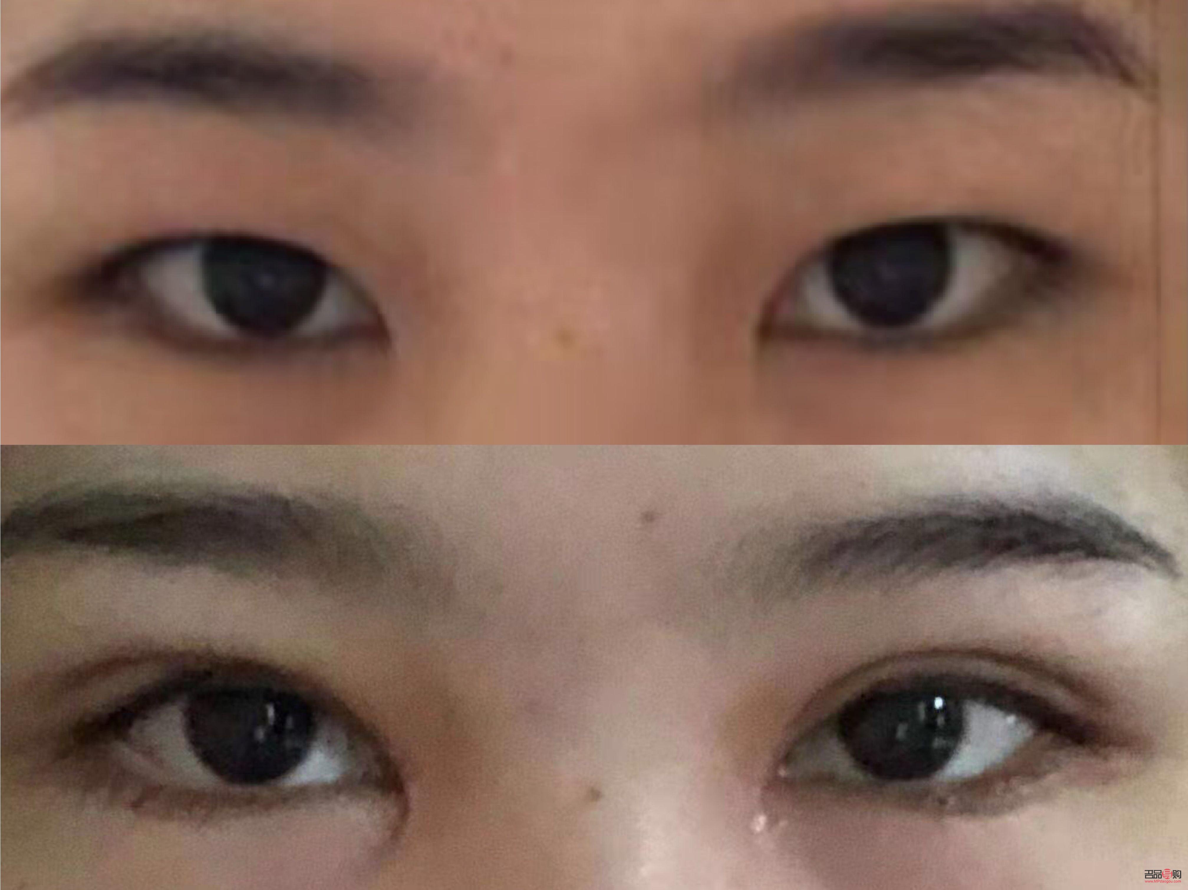 <h3>大小眼可以割雙眼皮嗎</h3>