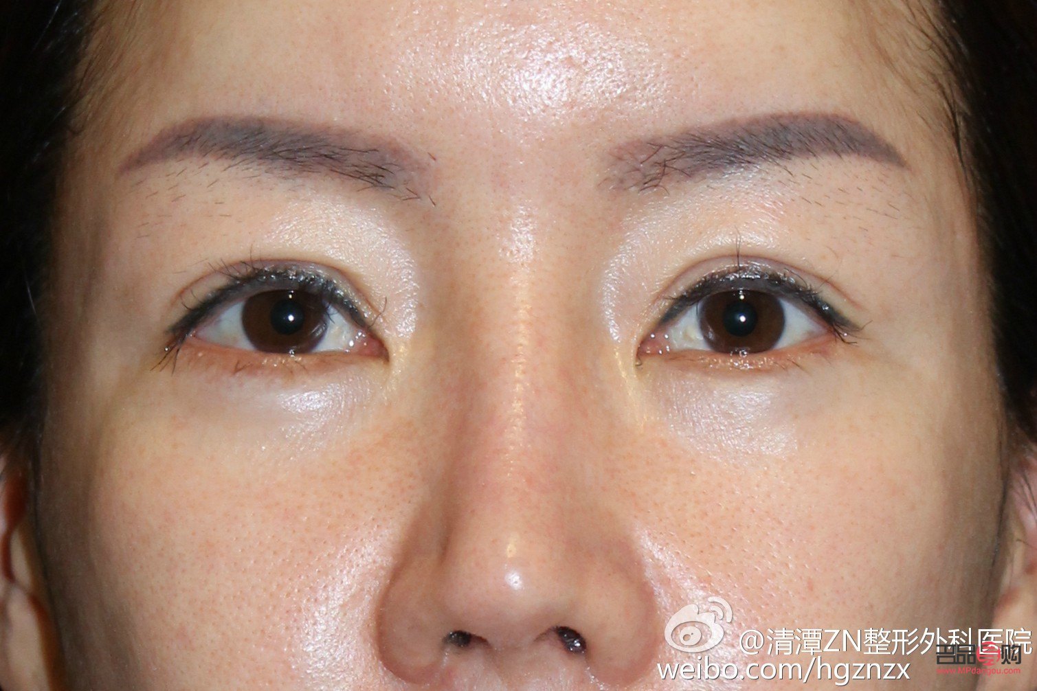 <h3>眼角下垂怎么提升和緊致眼角</h3>