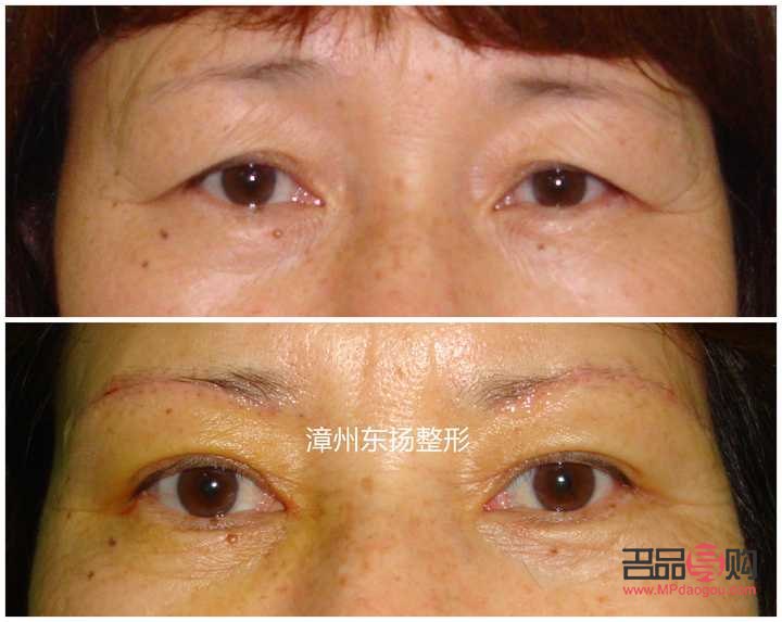 <h3>眼角下垂怎么提升和緊致眼角</h3>