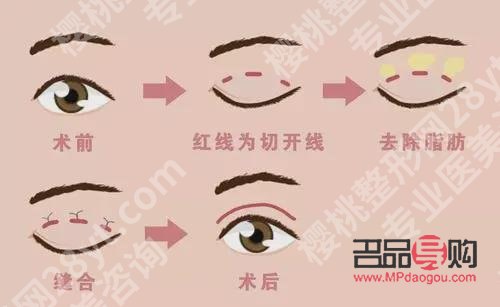 雙眼皮二次修復(fù)最佳時(shí)間：師麗麗專(zhuān)業(yè)解讀