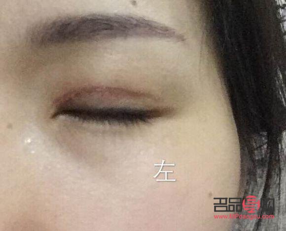 全切雙眼皮多久能恢復(fù)正常顏色