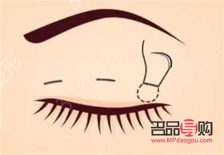 上眼皮抽脂是永久的嗎(上眼皮抽脂是永久的嗎)