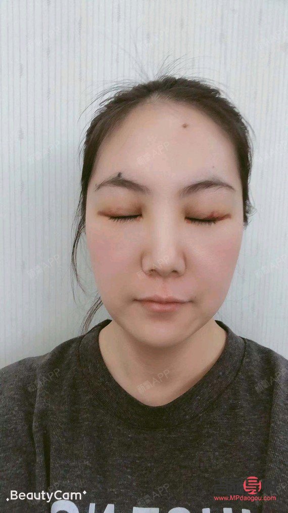 上眼皮抽脂是永久的嗎(上眼皮抽脂是永久的嗎)