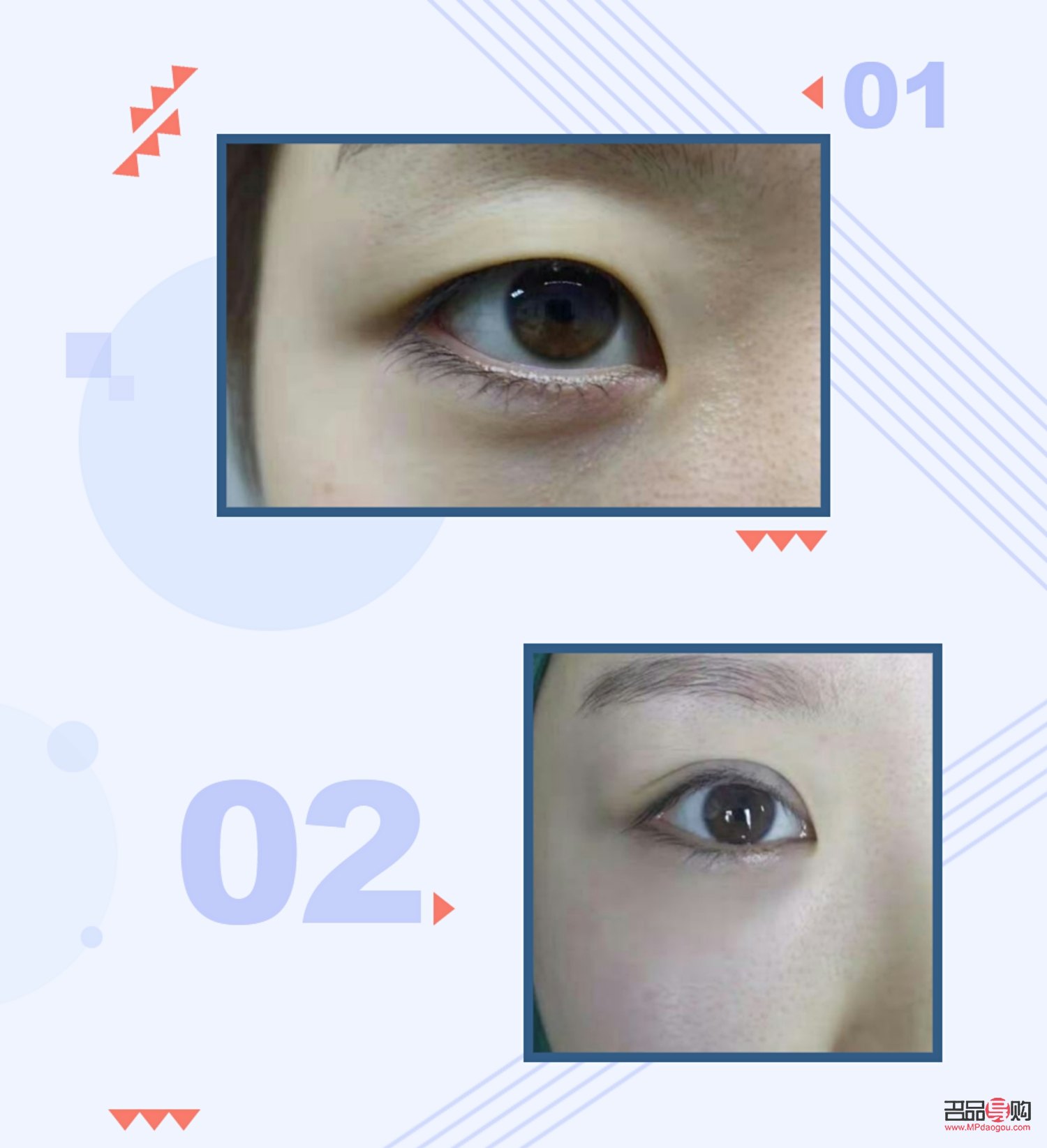 割雙眼皮手術(shù)多久恢復(fù)(割雙眼皮手術(shù)多久恢復(fù)正常)