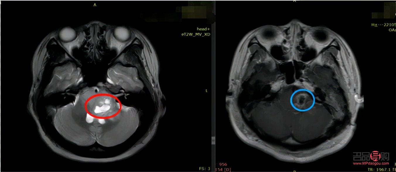 <h3>全切眼綜合手術(shù)費(fèi)用詳解</h3>