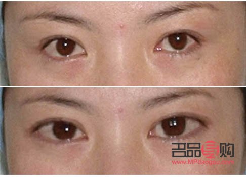 眼睛小做眼綜合會(huì)變大嗎(眼睛小做眼綜合會(huì)變大嗎圖片)