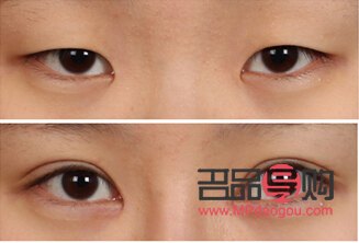 雙眼皮7mm恢復(fù)后多寬圖片女(雙眼皮7mm恢復(fù)后多寬圖片女生)