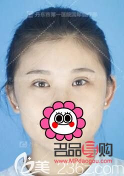 雙眼皮7mm恢復(fù)后多寬圖片女(雙眼皮7mm恢復(fù)后多寬圖片女生)