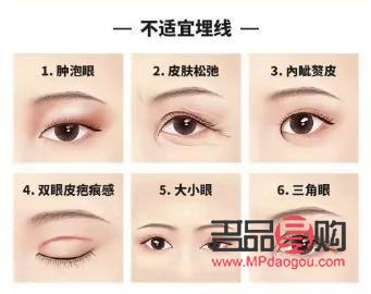 無痕跡雙眼皮與埋線雙眼皮的區(qū)別詳解