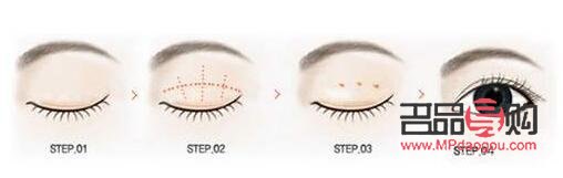 無痕跡雙眼皮與埋線雙眼皮的區(qū)別詳解