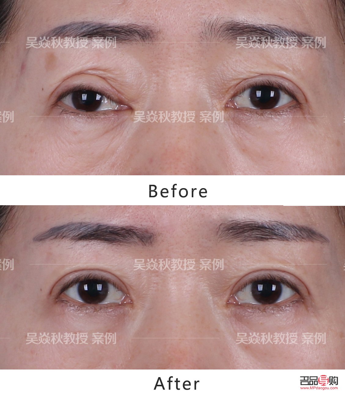 <h3>全切雙眼皮修復(fù)手術(shù)費(fèi)用詳解</h3>