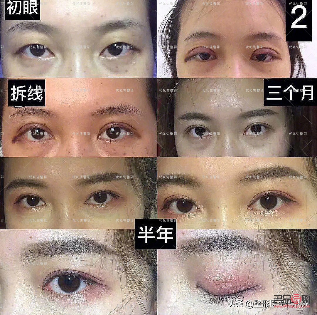 <h3>全切雙眼皮修復(fù)手術(shù)費(fèi)用詳解</h3>