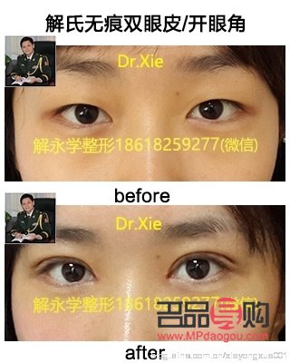 <h3>多層眼皮是否適合進(jìn)行雙眼皮手術(shù)？</h3>