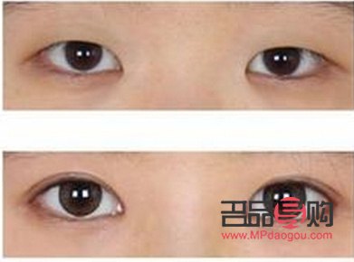 多層眼皮是否適合進(jìn)行雙眼皮手術(shù)？