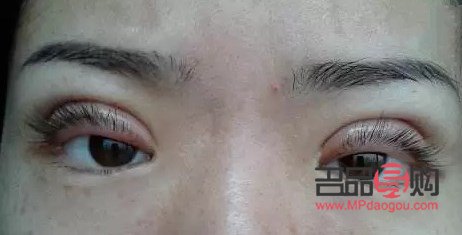 切割雙眼皮有何后遺癥？