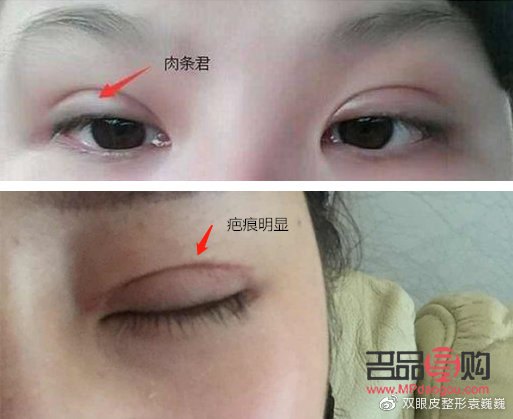 埋線跟全切雙眼皮哪個(gè)好(埋線跟全切雙眼皮哪個(gè)好點(diǎn))