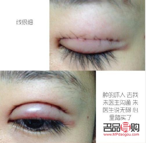 埋線跟全切雙眼皮哪個(gè)好(埋線跟全切雙眼皮哪個(gè)好點(diǎn))