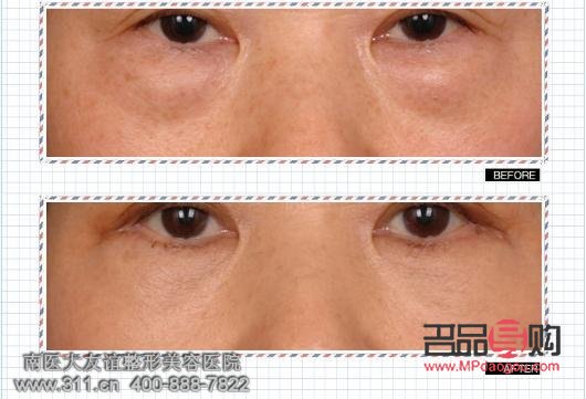 vottov去眼袋怎么樣(vmax去眼袋)