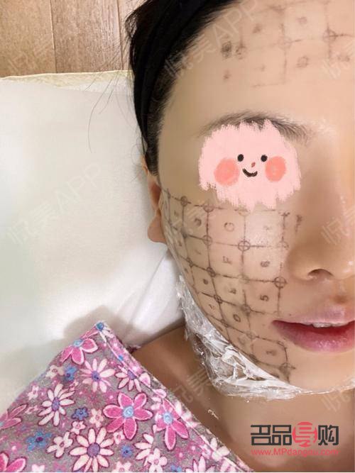 眼部熱瑪吉有恢復(fù)期嗎(眼部熱瑪吉多久恢復(fù))