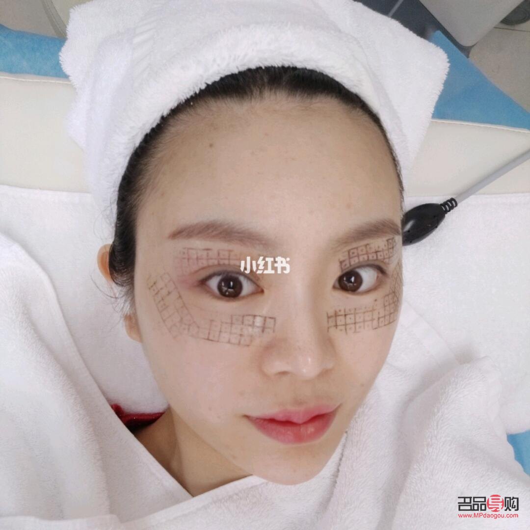 眼部熱瑪吉有恢復(fù)期嗎(眼部熱瑪吉多久恢復(fù))