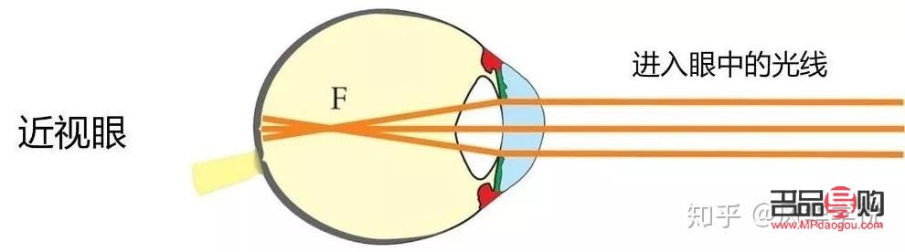 近視眼怎么樣自然恢復(fù)(近視眼怎么樣自然恢復(fù)正常)