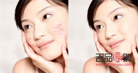 美容院排痘痘好嗎(美容院排痘痘好嗎知乎)