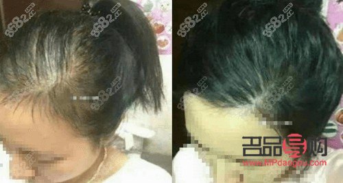 植發(fā)屬于美容嗎(植發(fā)屬于美容嗎知乎)