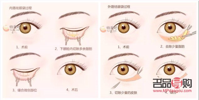 <h3>脂肪型眼袋的成因及解決方法探析</h3>