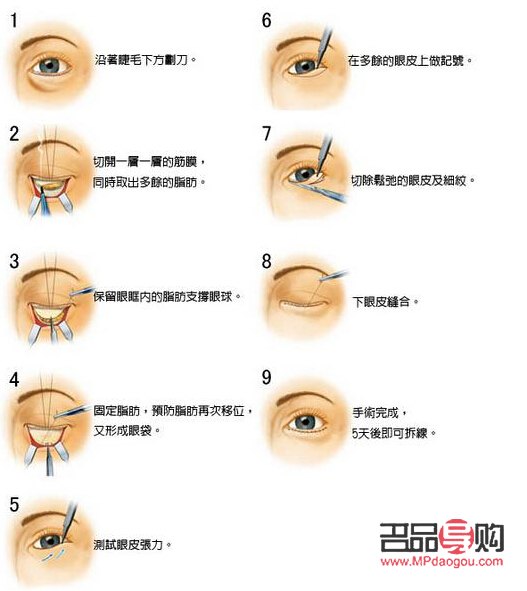 <h3>脂肪型眼袋的成因及解決方法探析</h3>