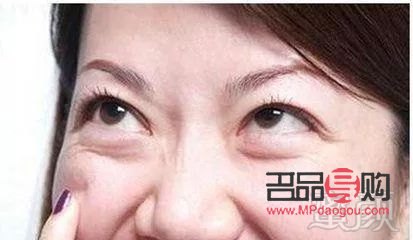 脂肪型眼袋的成因及解決方法探析