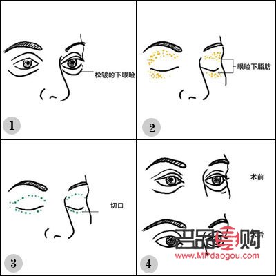 給眼皮抽脂要多少錢(qián)？全面解析眼皮抽脂價(jià)格因素