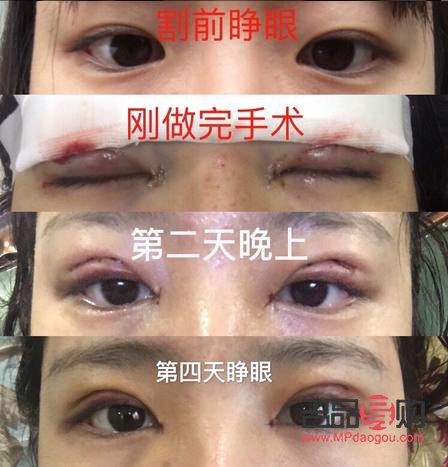 7.5mm開扇雙眼皮(7.5mm開扇雙眼皮圖片)