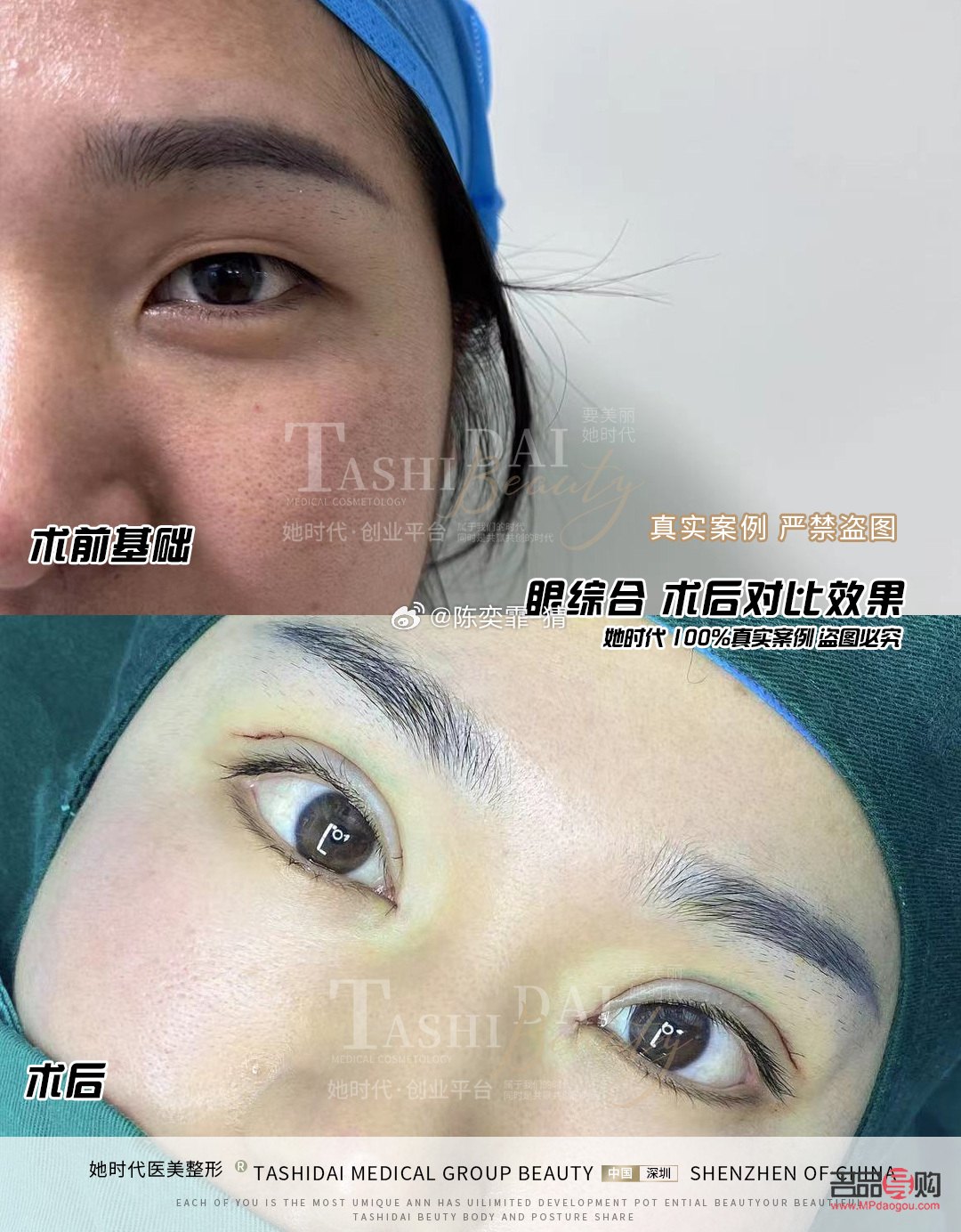 <h3>全切加眼綜合</h3>——打造迷人電眼新選擇