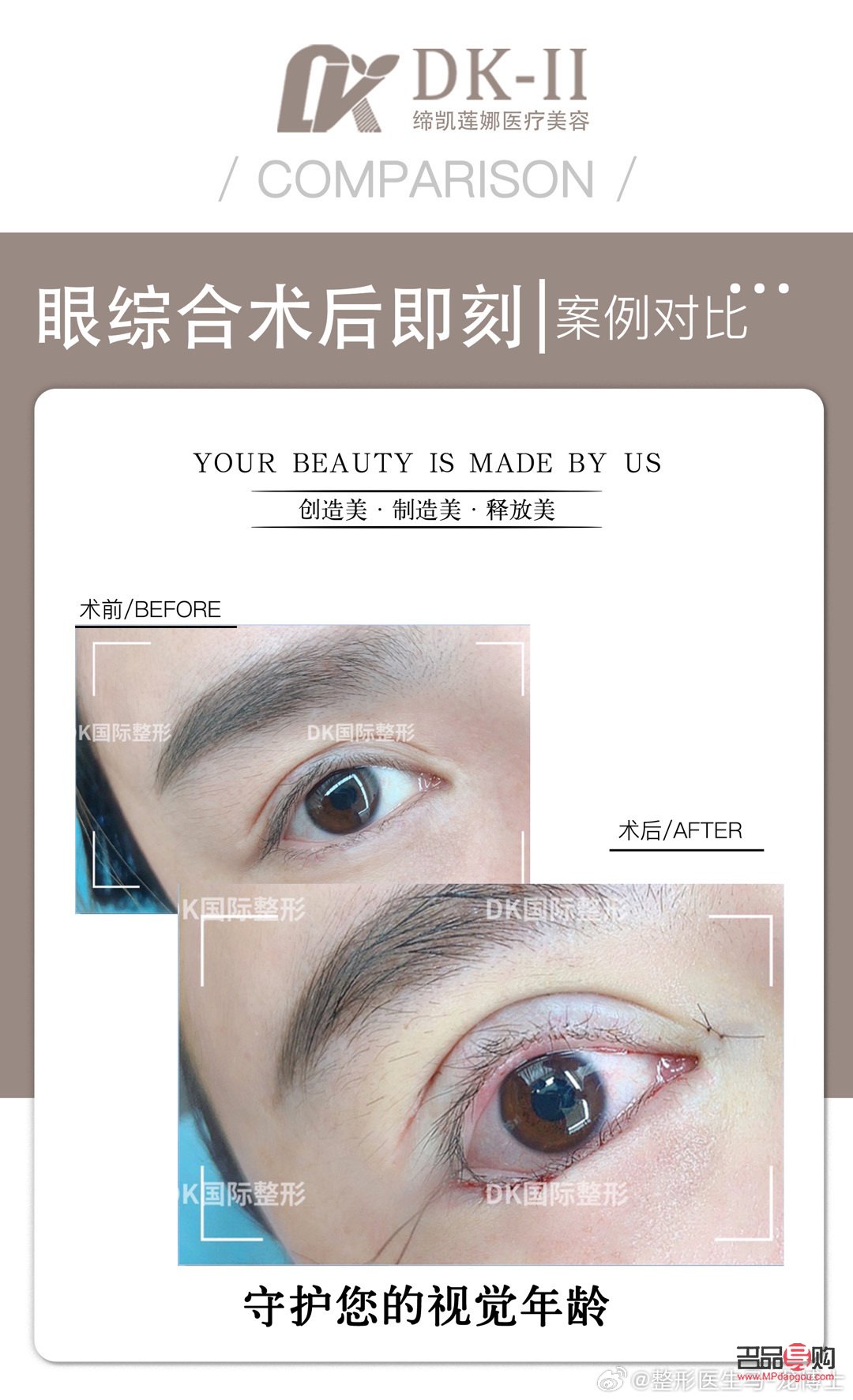 全切加眼綜合——打造迷人電眼新選擇