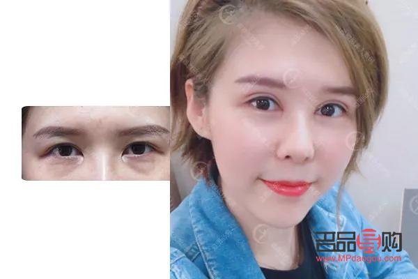 開扇形雙眼皮真人圖片(開扇形雙眼皮的圖片)