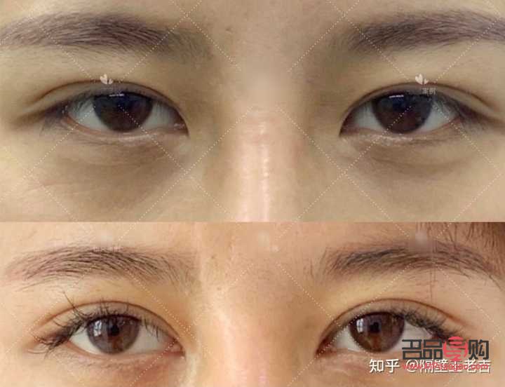 <h3>眼距寬割雙眼皮時是否需要開眼角？</h3>