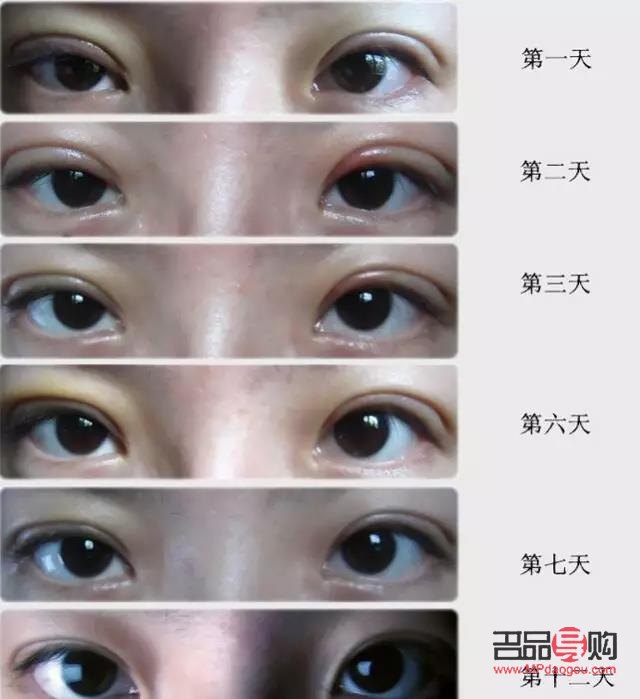 <h3>眼距寬割雙眼皮時是否需要開眼角？</h3>