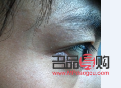 眼睛角有一小塊肉突出怎么辦(眼睛角有一小塊肉突出怎么辦圖片)