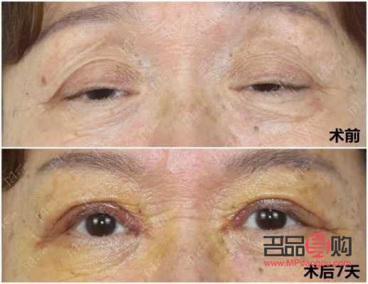 眼皮松弛下垂手術(shù)前后對(duì)比照片(眼皮松弛下垂手術(shù)多長(zhǎng)時(shí)間恢復(fù))