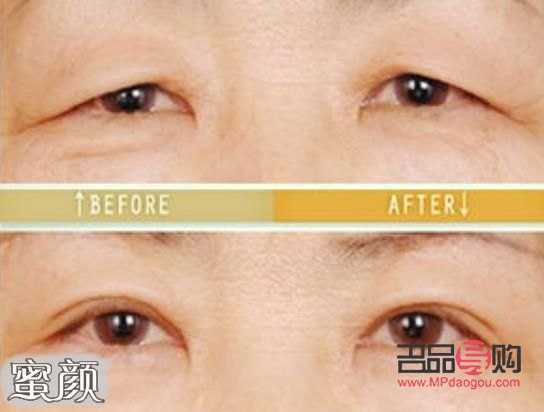 眼皮松弛下垂手術(shù)前后對(duì)比照片(眼皮松弛下垂手術(shù)多長(zhǎng)時(shí)間恢復(fù))