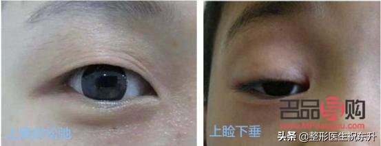 眼皮松弛下垂手術(shù)前后對(duì)比照片(眼皮松弛下垂手術(shù)多長(zhǎng)時(shí)間恢復(fù))