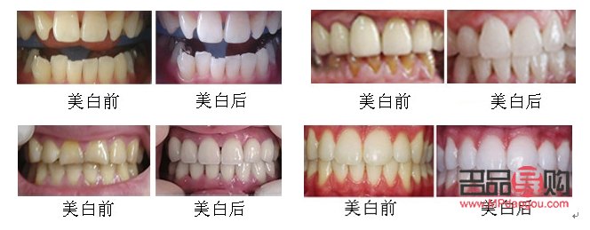 <h3>美容院整牙齒嗎？專業(yè)解答與注意事項</h3>