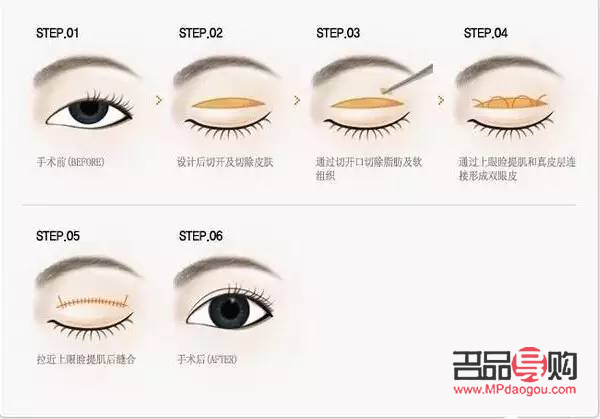 眼瞼提肌無(wú)力怎么治療