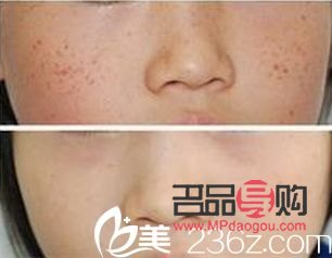 祛斑美容要多少錢(qián)(祛斑美容要多少錢(qián))